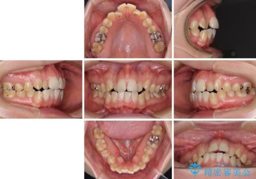 舌突出癖による開咬 舌のトレーニングを行いながら咬み合わせを改善の治療前