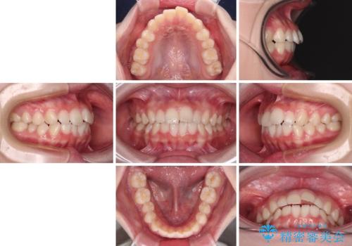 前歯のデコボコを治したい 高校生のインビザライン治療の治療前