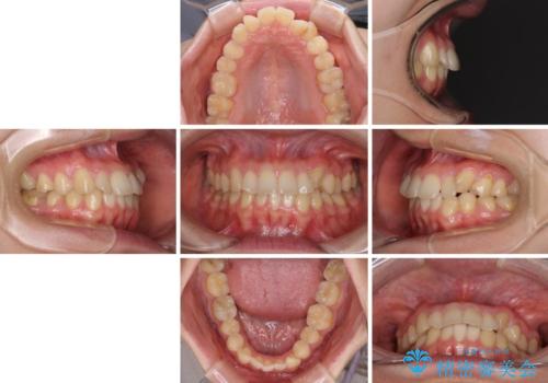 【モニター】1本欠損した下顎前歯と上顎の八重歯 ワイヤー装置で楽して矯正治療の治療前