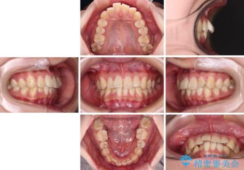 【モニター】捻れた前歯をスッキリと インビザライン矯正治療の治療前