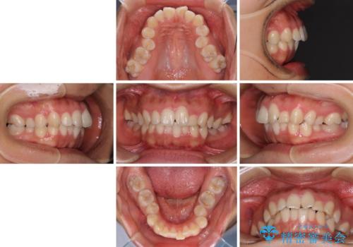【モニター】閉じにくい口元 ワイヤー装置での抜歯矯正の治療前