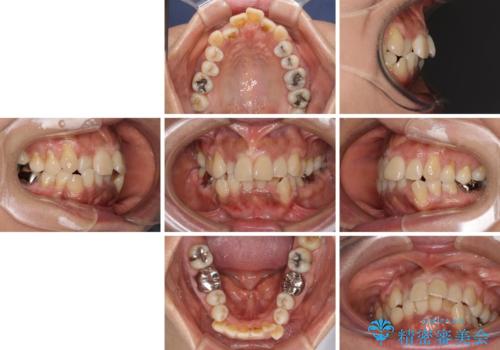 クロスバイトの前歯を治したい ワイヤー装置でも抜歯矯正の治療前