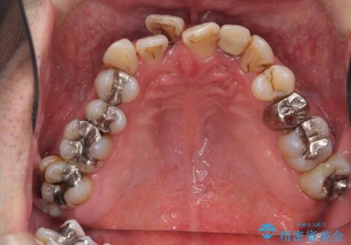 受け口 なんと部分矯正で治るんです!! インプラントを含めた総合歯科治療の治療前