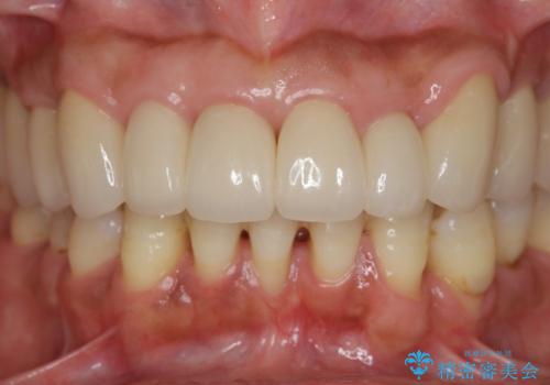 [ 再生治療・歯周外科・小矯正・セラミック補綴 ]  前歯の歯周病治療の治療後