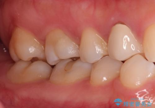 【VPT(歯髄温存療法)とセラミックインレー】深い虫歯でも神経を残したいの治療後