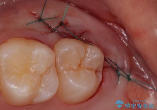 親知らずを抜きたいの治療中