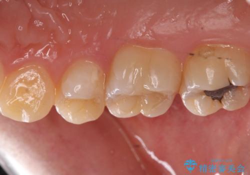 銀歯を白くしたいの治療前