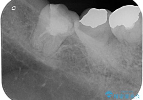 【根管治療】噛んだ時にしみる。最近になってズキズキ痛み、長引く痛みがあるの治療前