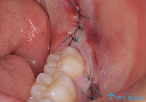 親知らずを抜きたいの症例 治療後