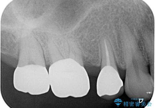【セラミッククラウン】インレーが外れた。の治療後