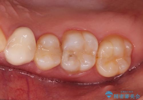【VPT(歯髄温存療法)とセラミックインレー】深い虫歯でも神経を残したいの症例 治療前