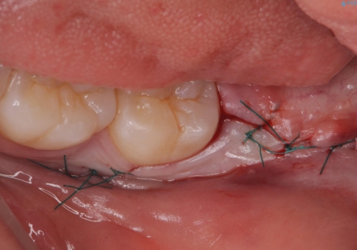 親知らずを抜きたいの治療中