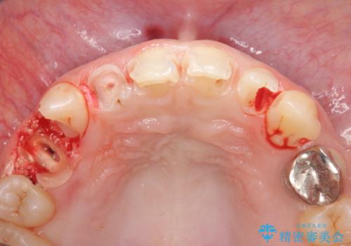 多発した前歯の重度虫歯治療の治療前