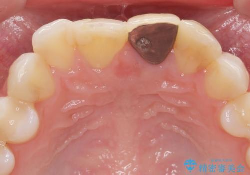 前歯の見た目を改善 セラミック審美治療の治療前