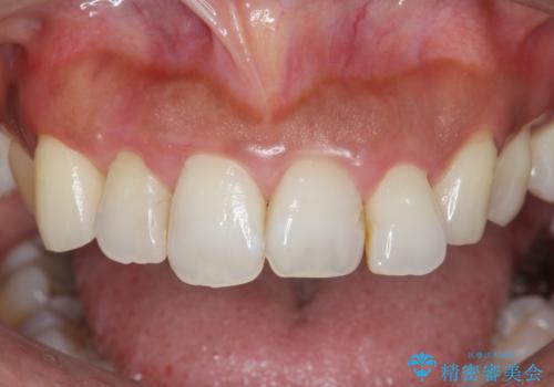 [ 再生治療・歯周外科・小矯正・セラミック補綴 ]  前歯の歯周病治療の症例 治療前