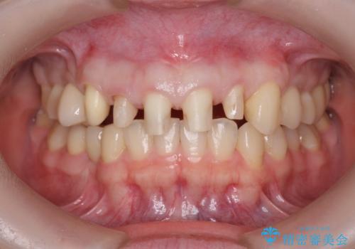 多発した前歯の重度虫歯治療の治療中