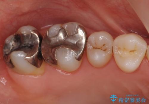 銀歯を白くしたい　セラミッククラウンでの治療の症例 治療前