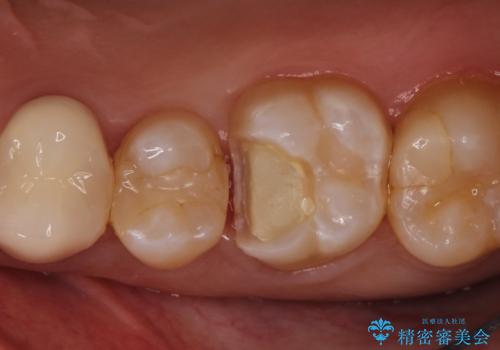 【VPT(歯髄温存療法)とセラミックインレー】深い虫歯でも神経を残したいの治療中