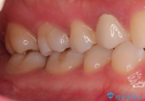 【VPT(歯髄温存療法)とセラミックインレー】深い虫歯でも神経を残したいの治療前