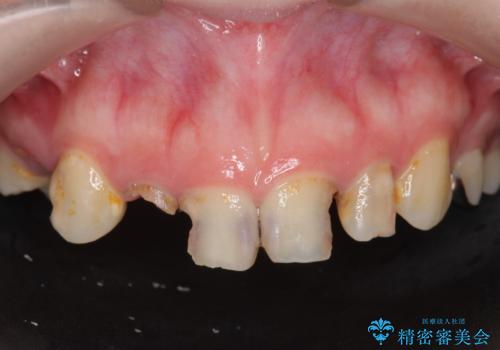 多発した前歯の重度虫歯治療の症例 治療前