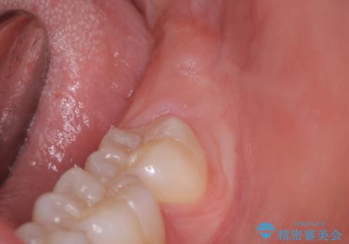 親知らずを抜きたいの症例 治療前