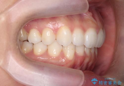 歯を抜かずに後方移動で達成する、前突感の改善の治療後