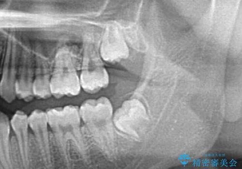 親知らずを抜きたいの治療前
