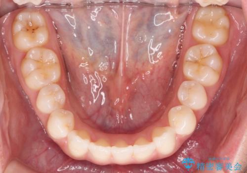 歯を抜かずに後方移動で達成する、前突感の改善の治療後