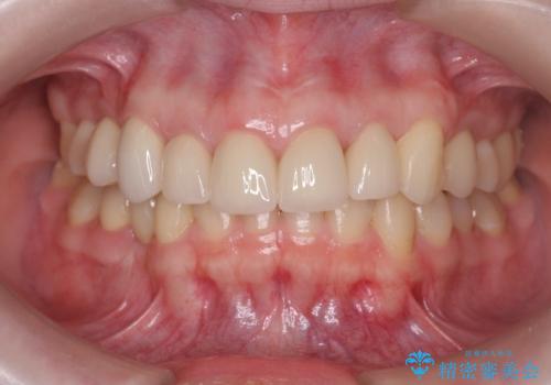 多発した前歯の重度虫歯治療の治療後