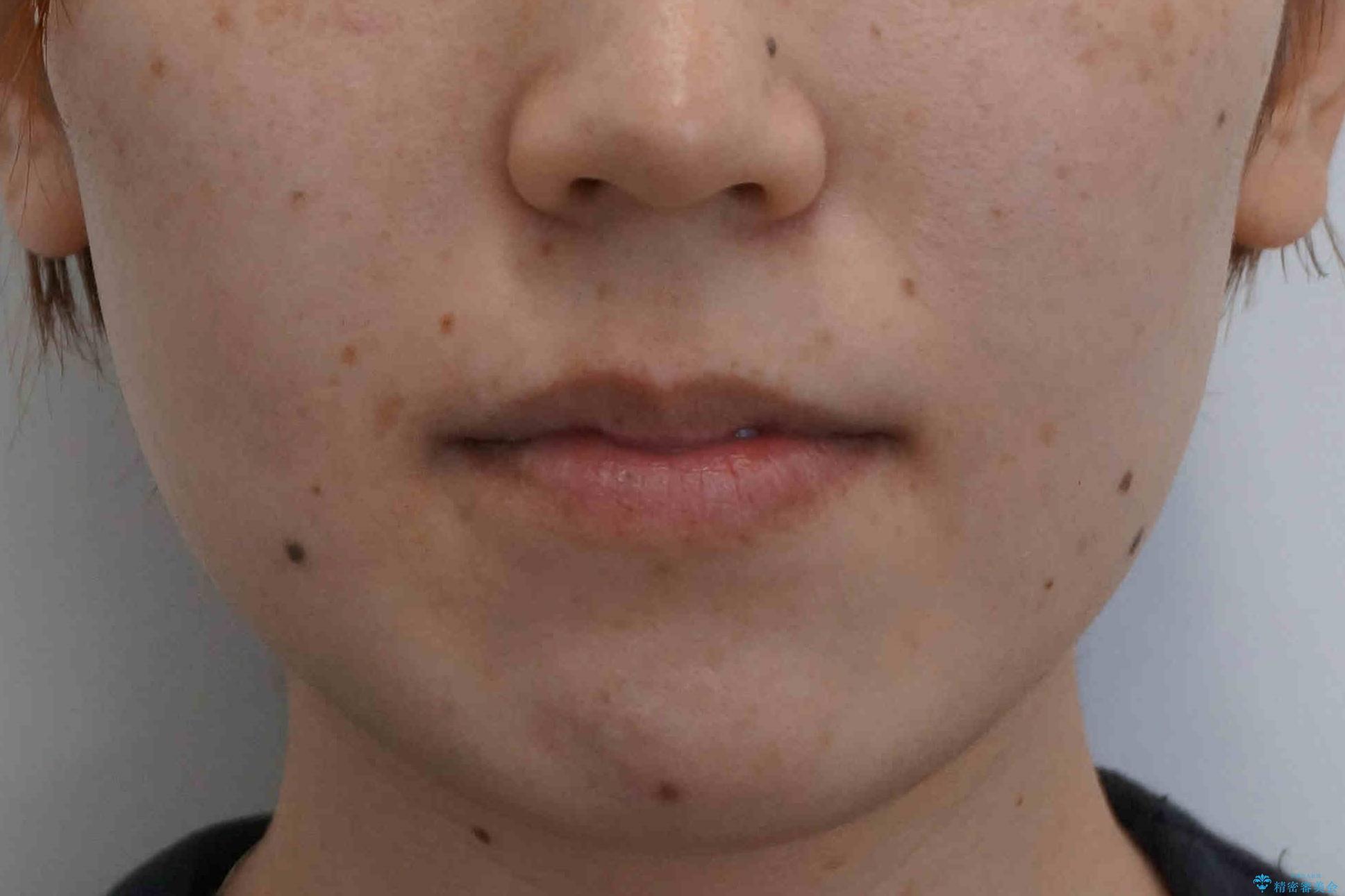 下の歯のがたつき 上より気になるの治療前(顔貌)