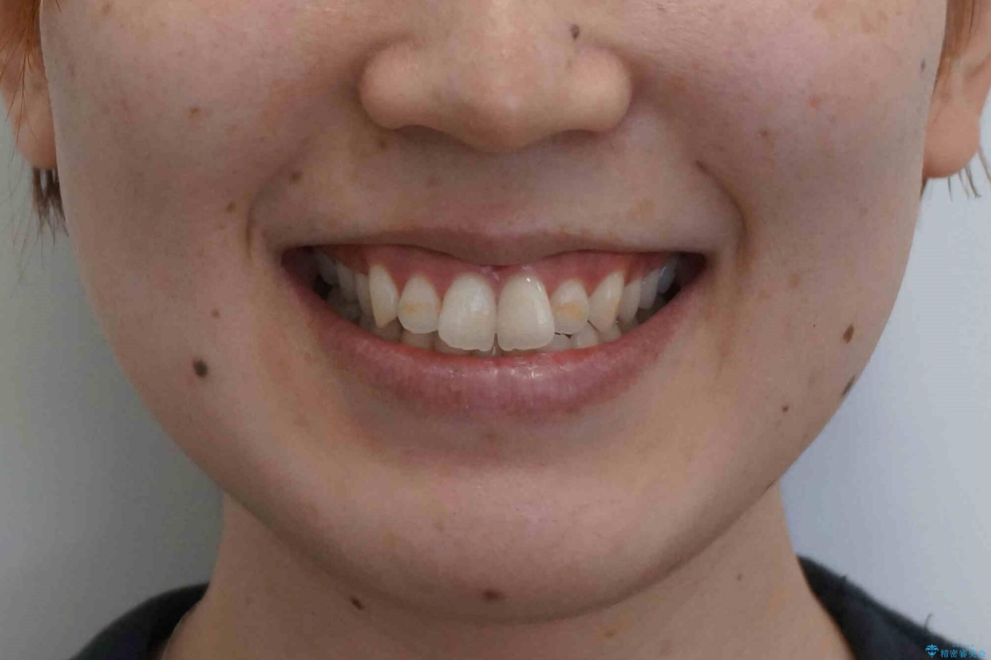 下の歯のがたつき 上より気になるの治療前(顔貌)