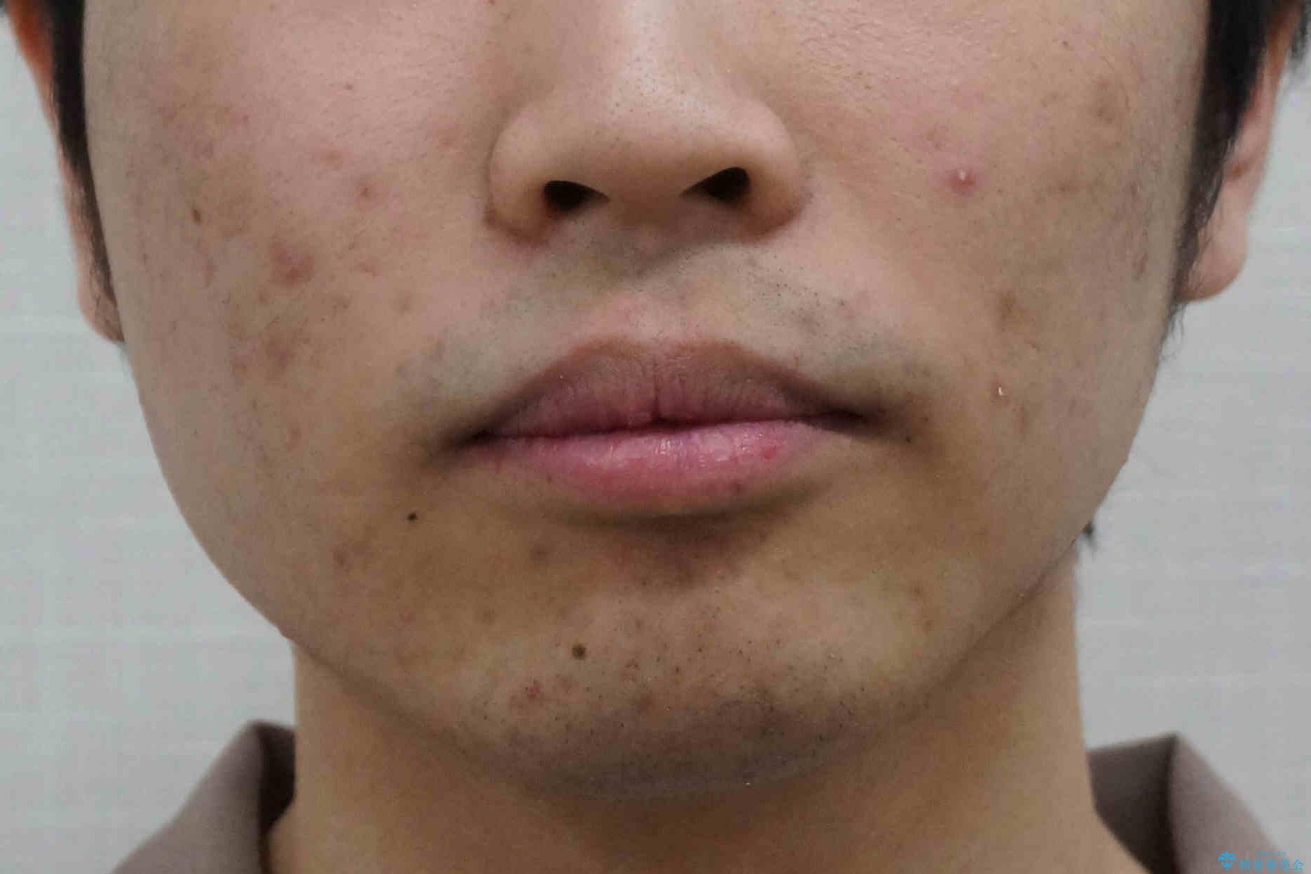 出っ歯が気になる 歯をぬかずに治療の治療前(顔貌)