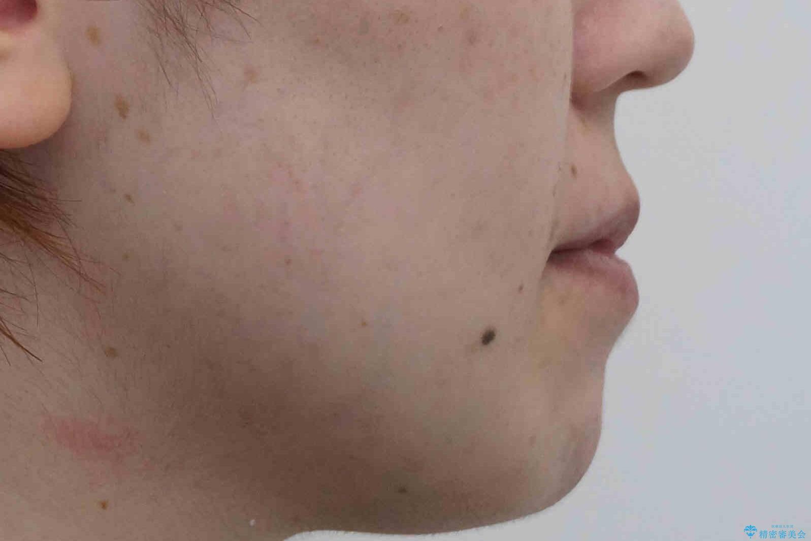 下の歯のがたつき 上より気になるの治療前(顔貌)