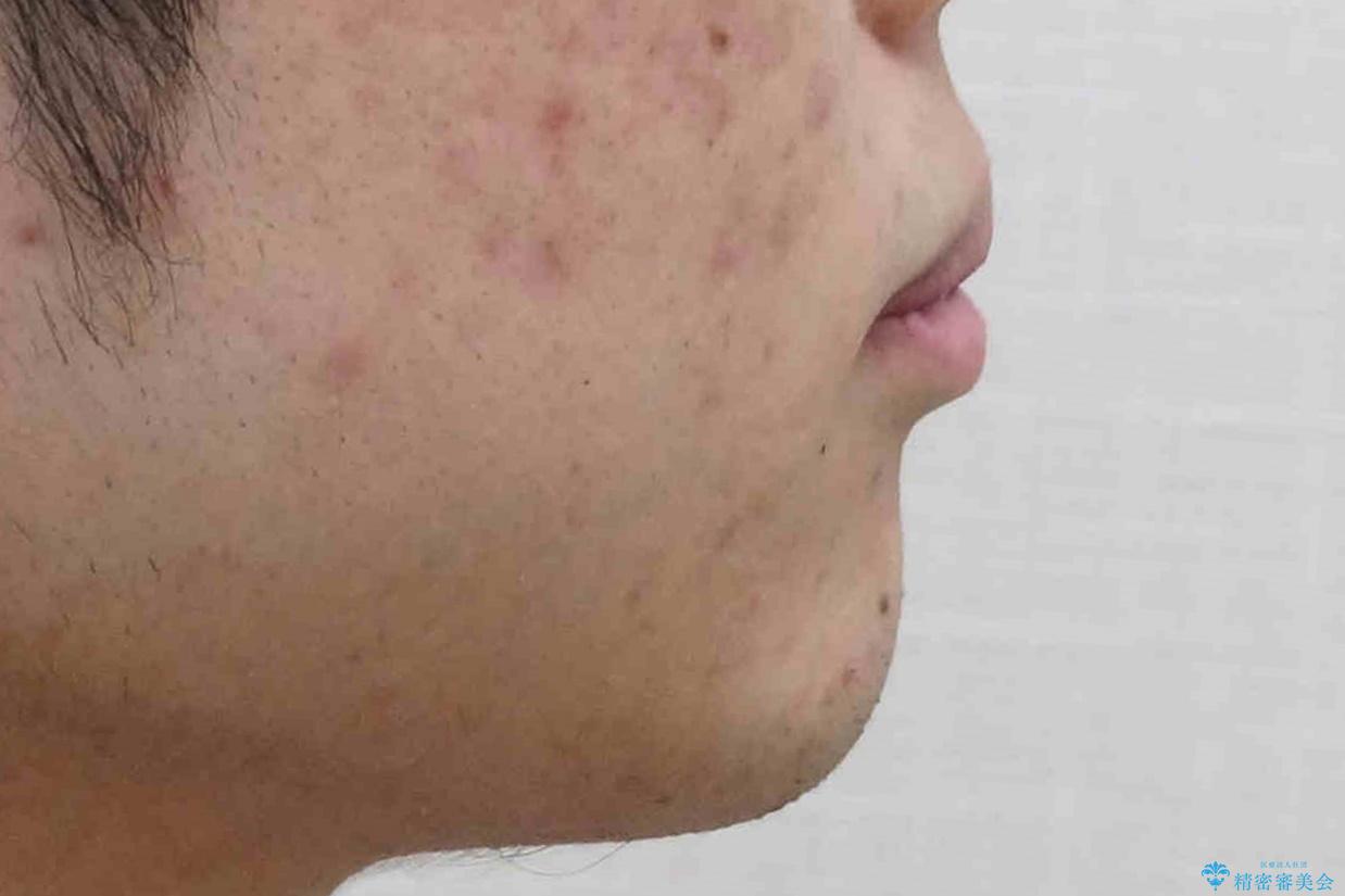 出っ歯が気になる 歯をぬかずに治療の治療前(顔貌)