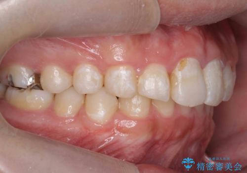 出っ歯が気になる 歯をぬかずに治療の治療後