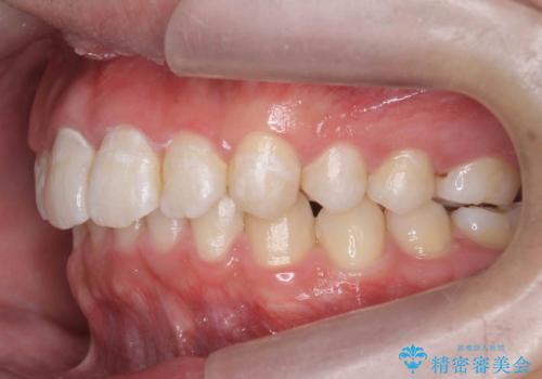 出っ歯が気になる 歯をぬかずに治療の治療後