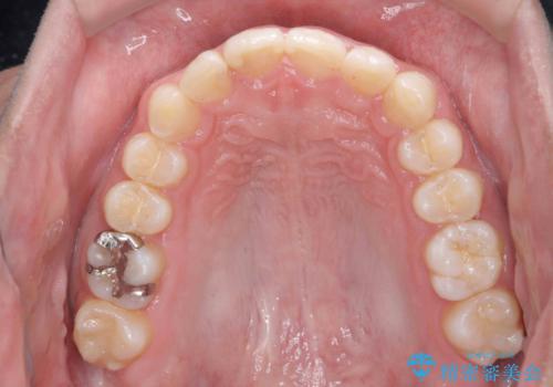 出っ歯が気になる　歯をぬかずに治療の治療後