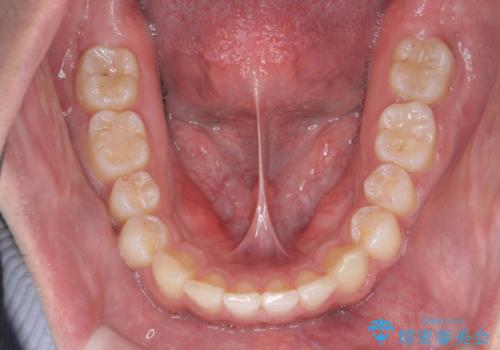 出っ歯が気になる　歯をぬかずに治療の治療後