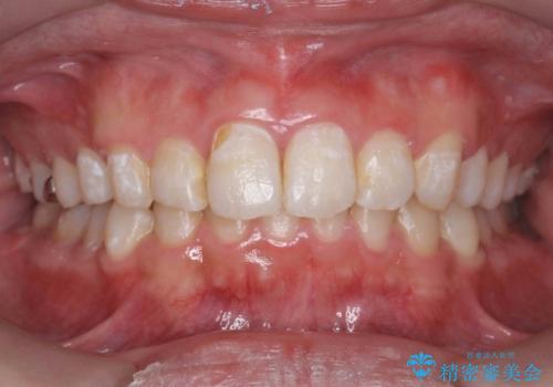 出っ歯が気になる　歯をぬかずに治療の症例 治療後