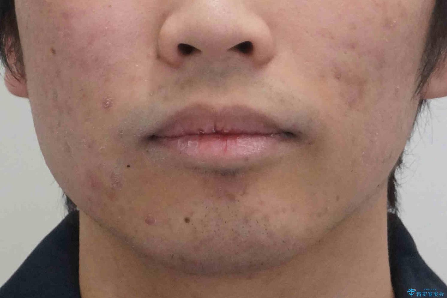 出っ歯が気になる 歯をぬかずに治療の治療後(顔貌)