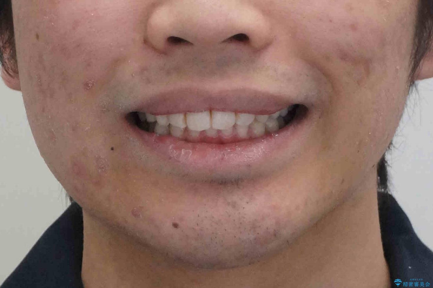 出っ歯が気になる 歯をぬかずに治療の治療後(顔貌)