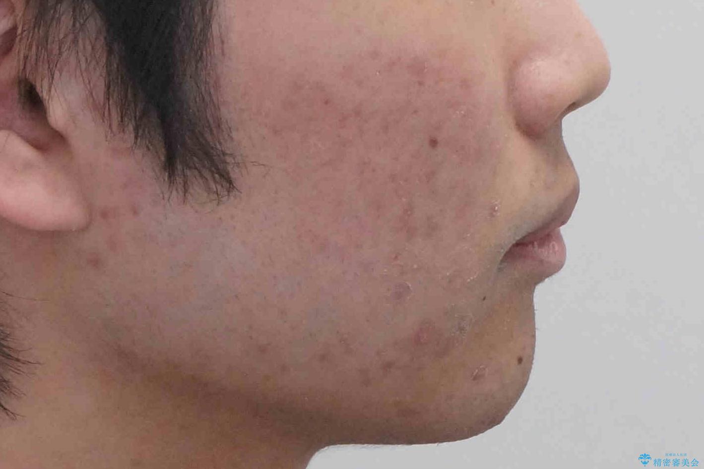 出っ歯が気になる 歯をぬかずに治療の治療後(顔貌)