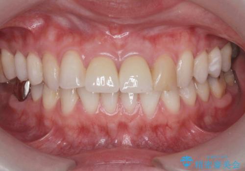 前歯の見た目を改善 セラミック審美治療の治療後