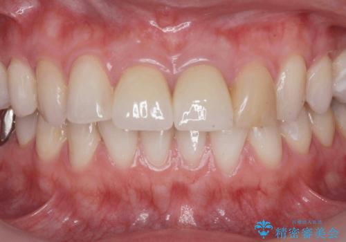 前歯の見た目を改善 セラミック審美治療の治療後