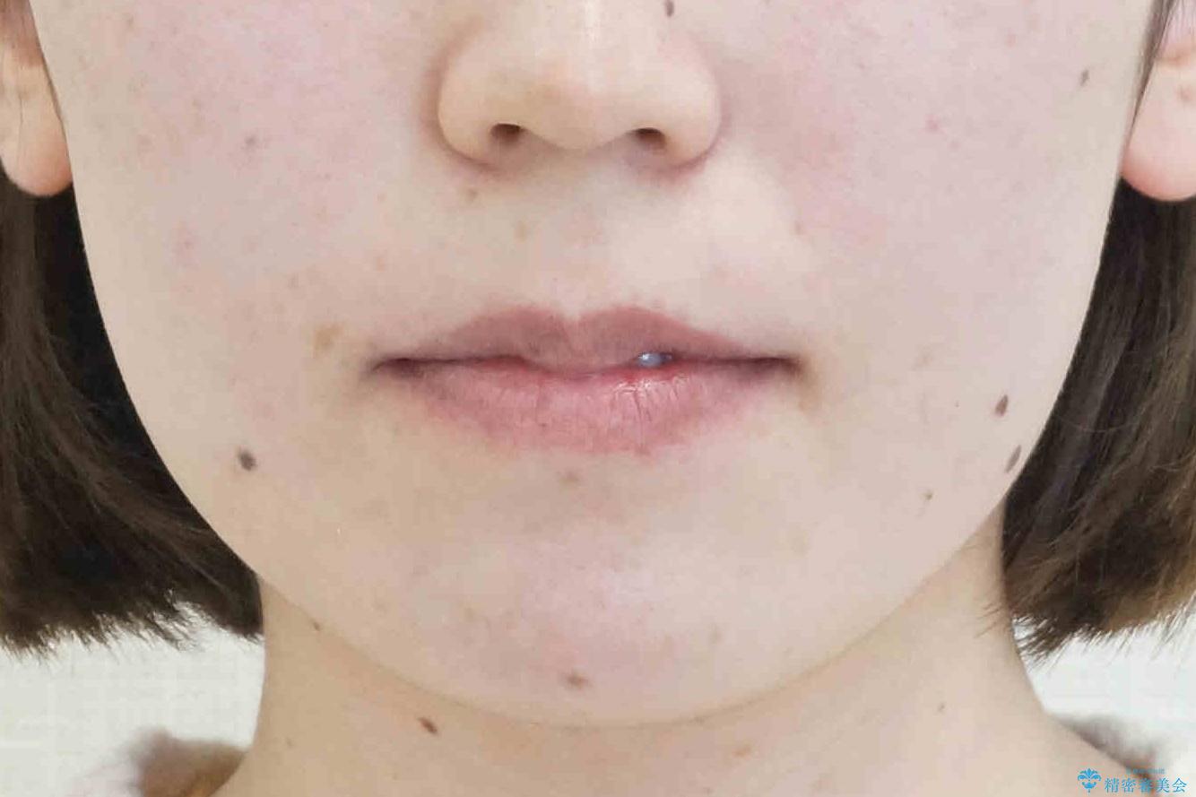 下の歯のがたつき 上より気になるの治療後(顔貌)