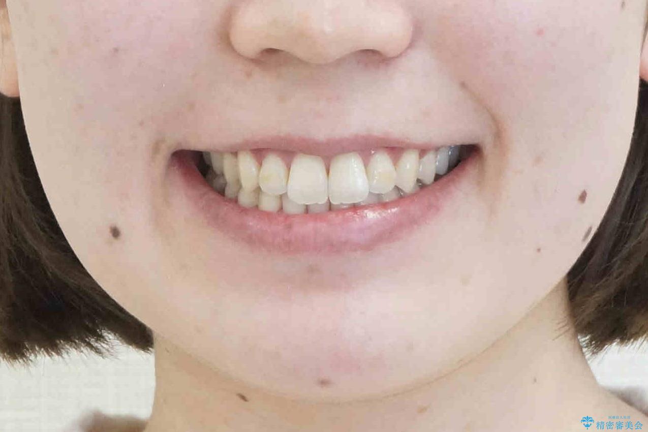下の歯のがたつき　上より気になるの治療後（顔貌）