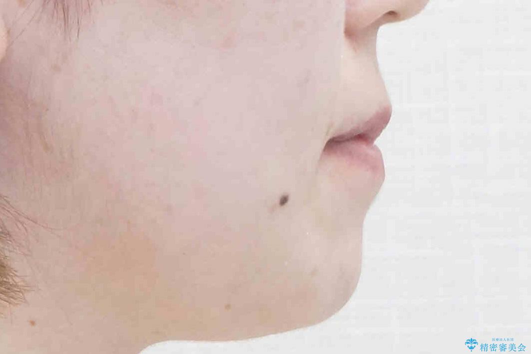 下の歯のがたつき 上より気になるの治療後(顔貌)