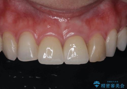 前歯の見た目を改善 セラミック審美治療の症例 治療後