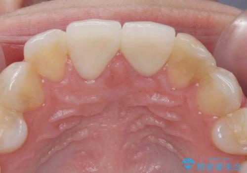 前歯の見た目を改善 セラミック審美治療の治療後