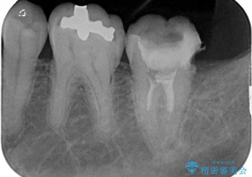 治療途中で転院 奥歯のセラミック補綴治療の治療前